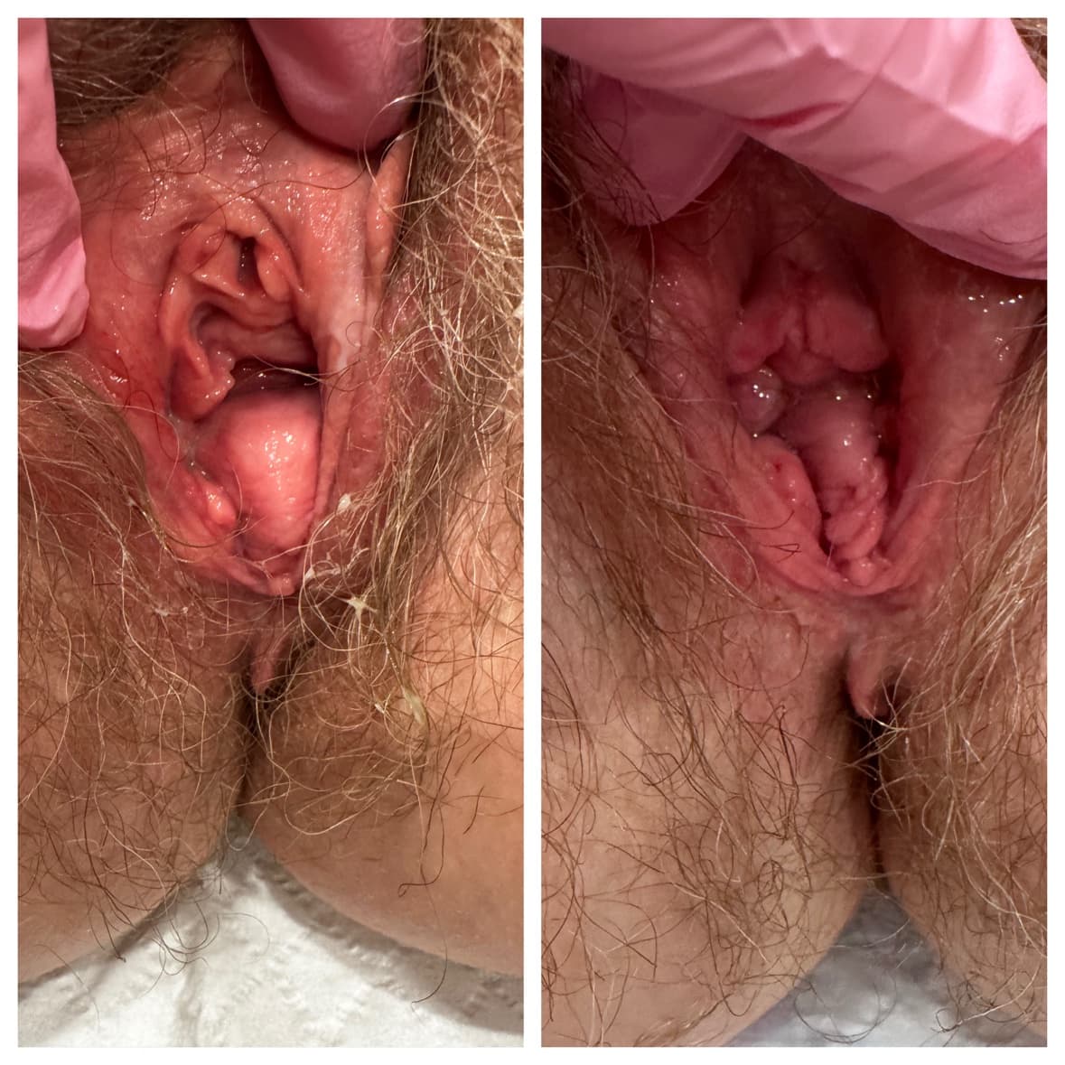 Flower Facelift™ before-and-after result 12 — vaginal rejuvenation at The Sonography Studio