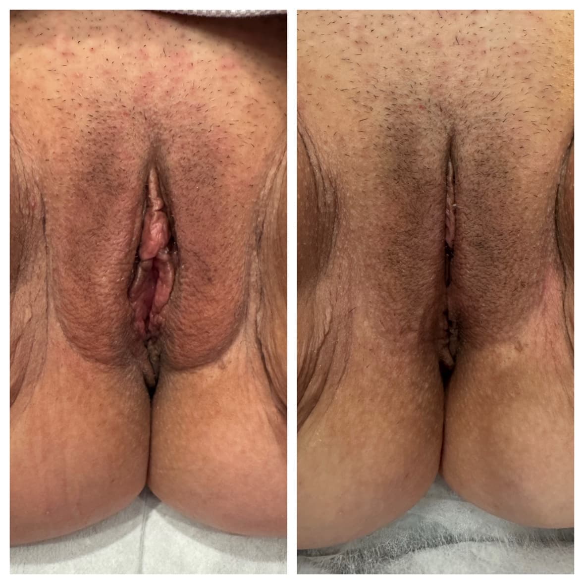 Flower Facelift™ before-and-after result 5 — vaginal rejuvenation at The Sonography Studio