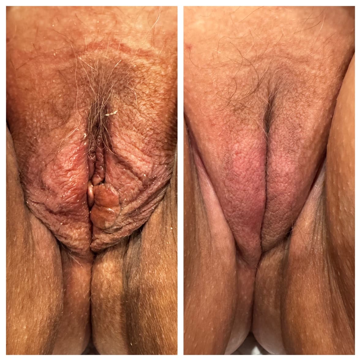 Flower Facelift™ before-and-after result 6 — vaginal rejuvenation at The Sonography Studio