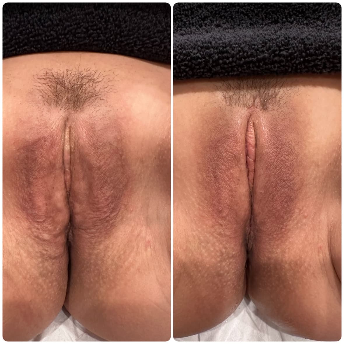 Flower Facelift™ before-and-after result 8 — vaginal rejuvenation at The Sonography Studio